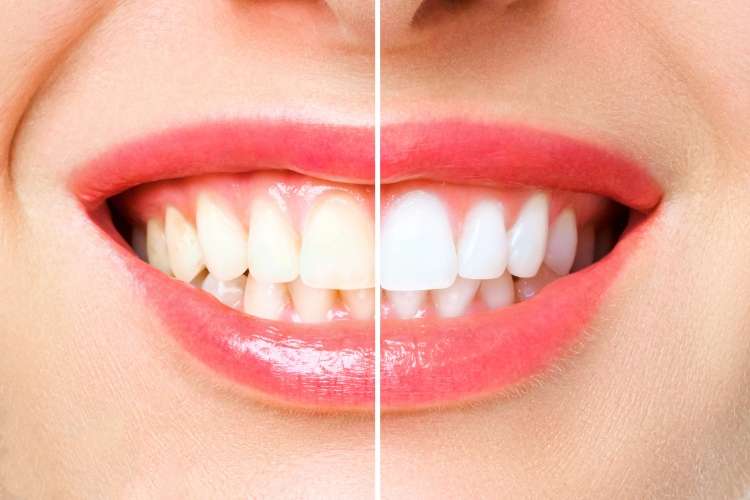 Teeth whitening by dentists in Cambridgeshire