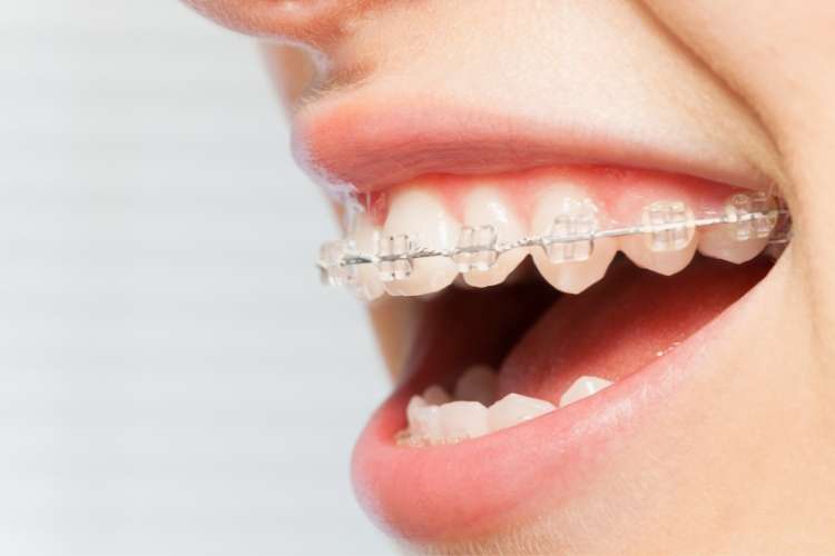 Adult and children's orthodontics by expert orthodontists in East Anglia