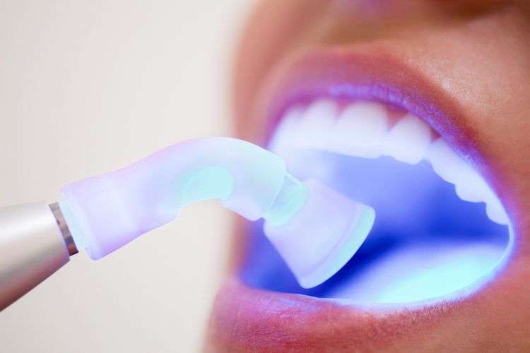 Dental Fillings by expert dentists