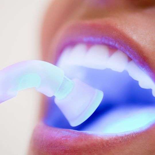 Dental Fillings by expert dentists