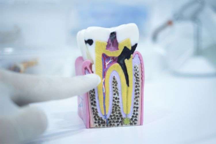Root canal surgery and root fillings at Serpentine Green Dental