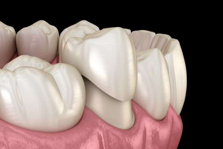 Crowns for general dental and cosmetic dentistry in Peterborough