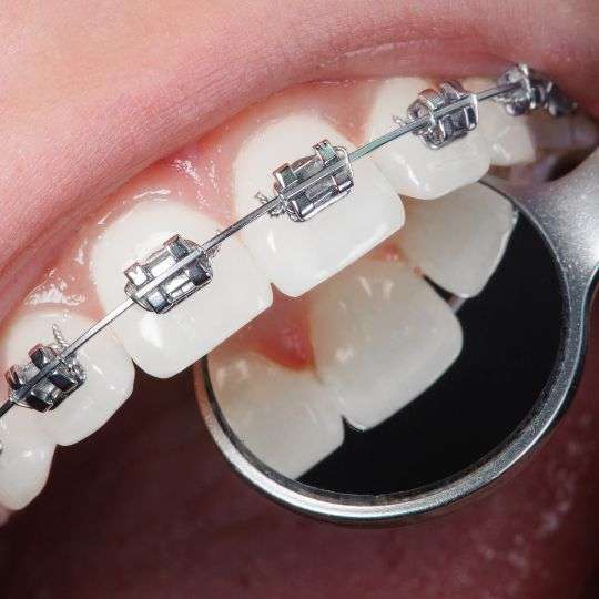 Orthodontics for children and adults