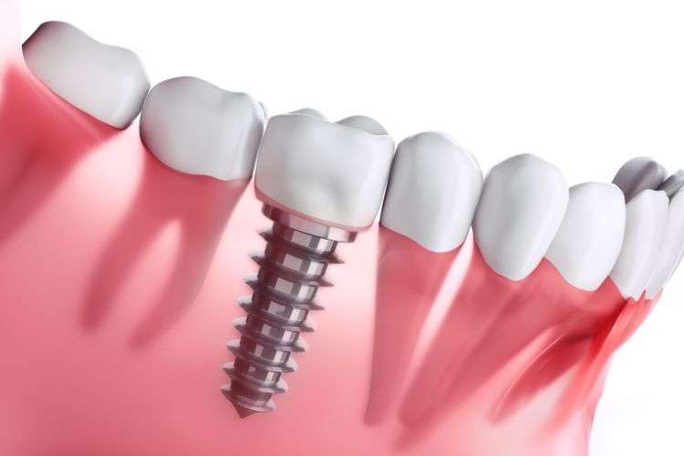 Dental implant surgery in Cambridgeshire