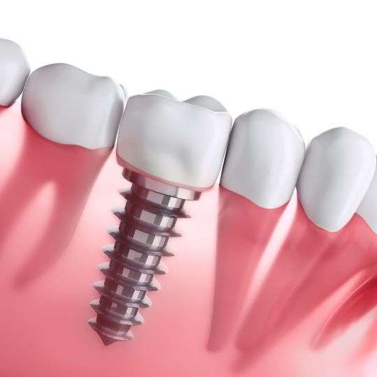 Dental implant surgery in Cambridgeshire